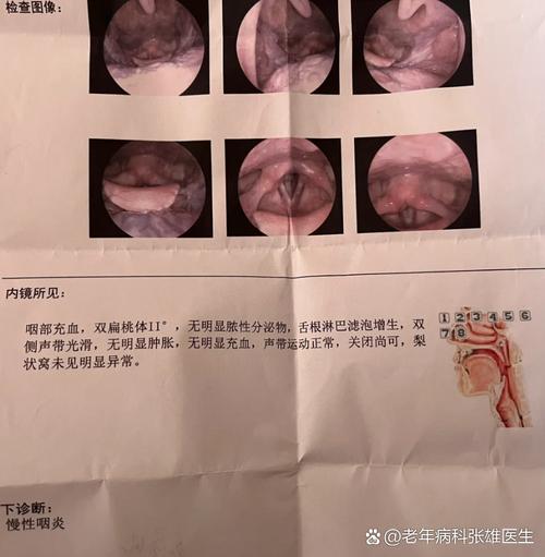 每次使用后要清洗并晾干雾化器 守护疗效与健康的关键一步
